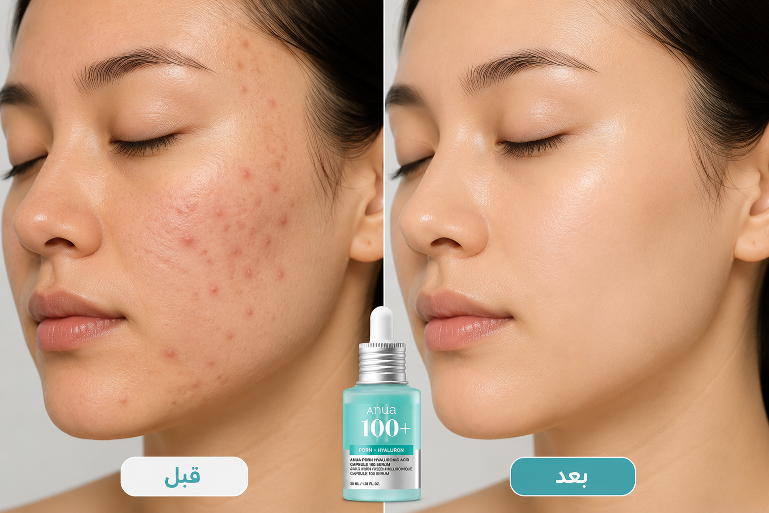 قبل وبعد ANUA 100