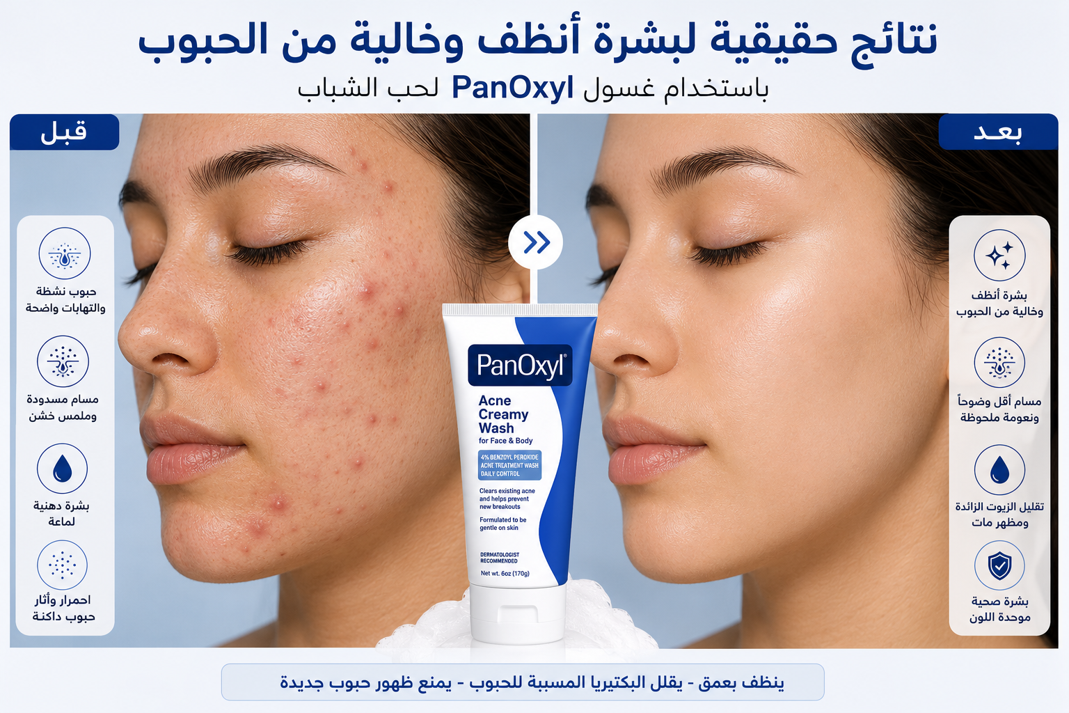 قبل وبعد Panoxyl Acne Creamy Wash Benzoyl Peroxide 4%